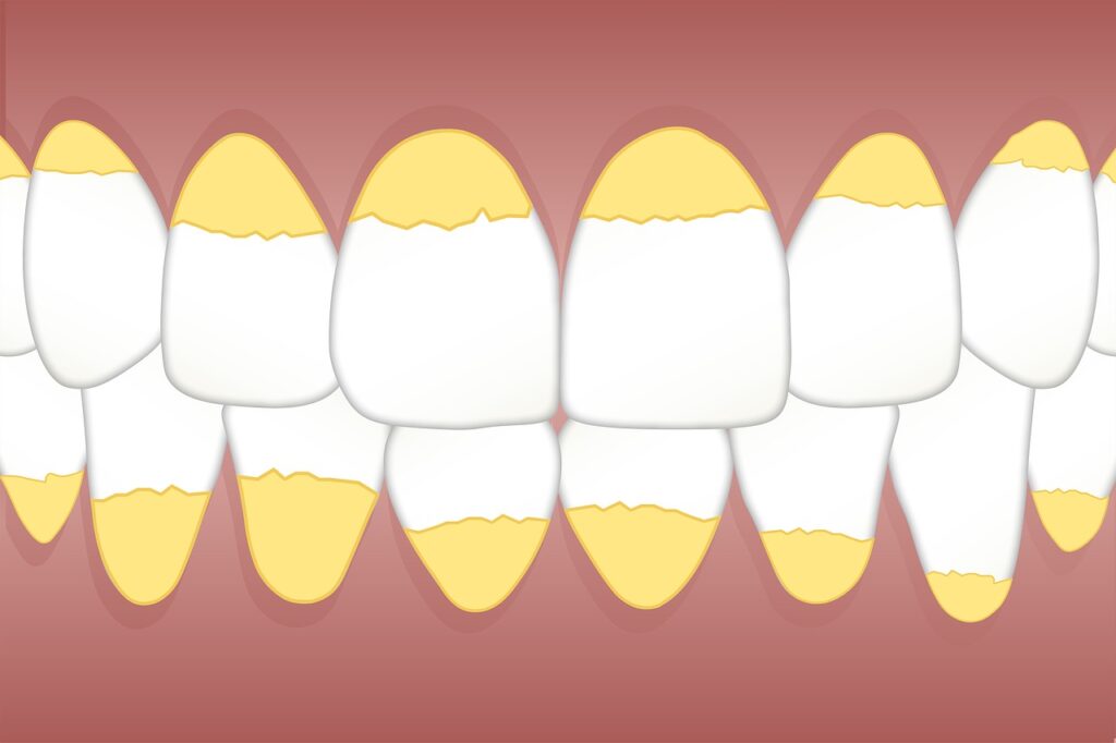 dental, calculus, teeth-3599734.jpg